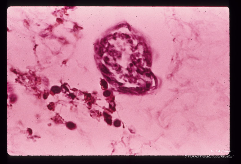 Cross section through larva found in pleural effusion of patient in Mt. Kisco, New York.