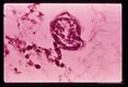 Cross section through larva found in pleural effusion of patient in Mt. Kisco, New York.