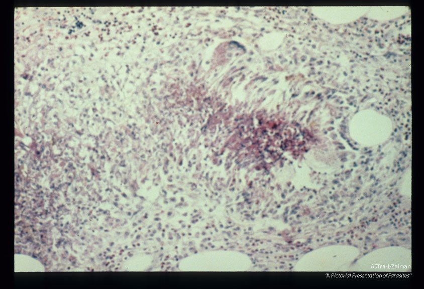 Multiple sections through anisakid nematodes and inflammatory infiltrate they induced in a human cecum.