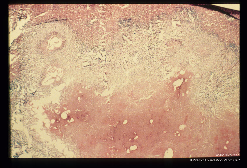 Gross and microscopic photos of human liver from Minnesota where about one half of the red foxes are infected.