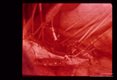 Mobilization of hepatic vein and insertion of tubing leading to bypass filter.