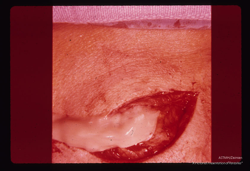 Incision into cyst permits escape of pseudopurulent material.