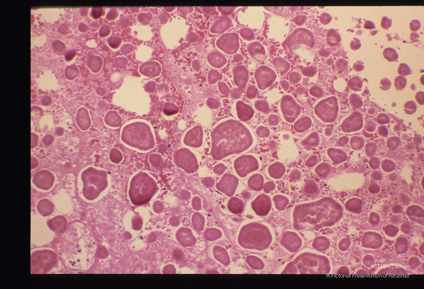 These slides are from a second such case. Reference Amer. Journ. Surg. Path. '11(8): 598-605,1987.