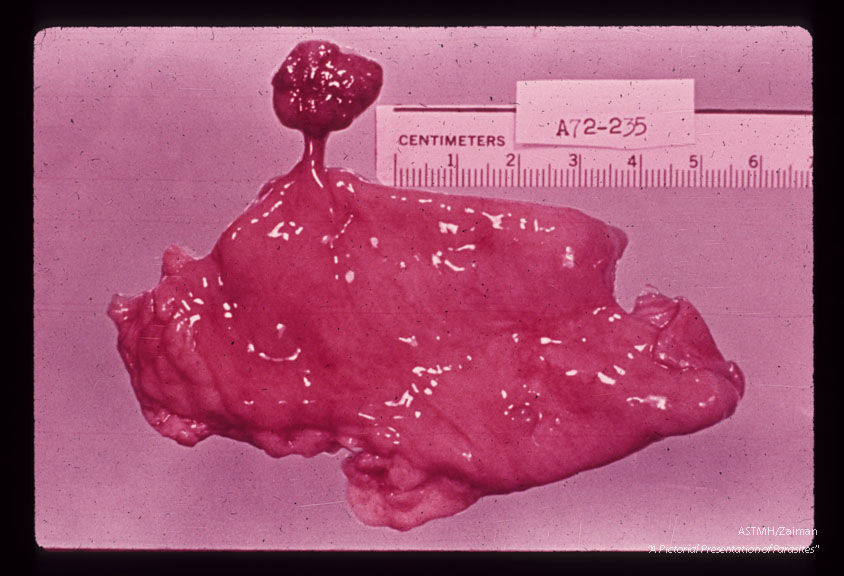 Same patient had a stalked polyp of the sigmoid colon. The polyp contained numerous eggs of S. haematobium and a few eggs of S. mansoni. Isolated intestinal polyps are not infrequent amoung Egyptians infected with S. mansoni or S. haematobium. They are less frequently seen in Brazilians suffering from S. mansoni infections.