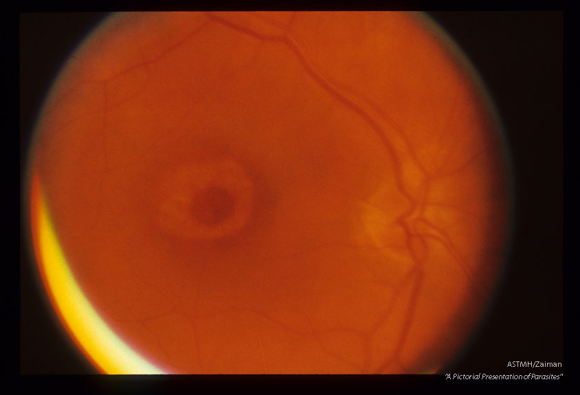 Toxic macular defect presenting as a "bull's eye".
