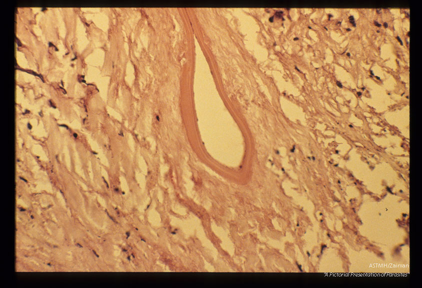 Gross and microscopic photos of human liver from Minnesota where about one half of the red foxes are infected.