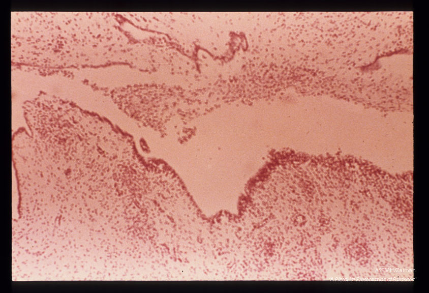 Encephalitis showing fourth ventricle not surrounded by necrosis. Instead, microglial nodule and watery inflammatory reactions accompany ulceratio in the ependyma. The foramina of Luschka and Magendi were open.