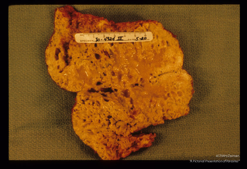 Portion of infected human liver.