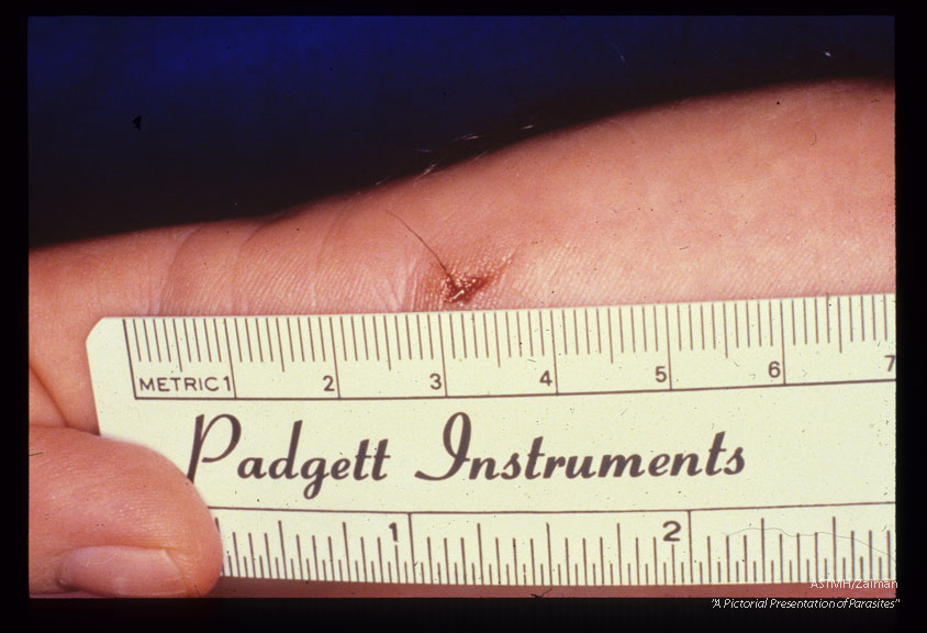 Gross views of hand with inplanted nematode in preexisting puncture wound.