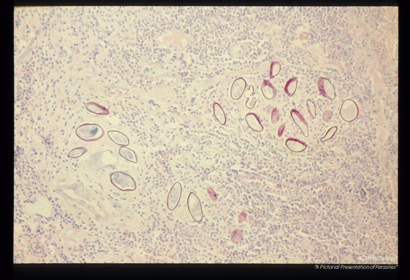 Multiple sections through appendix. Note that the eggs are acid fast.