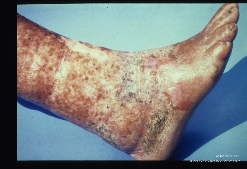 Elephantiasis, desquamation, thinning, and hyperkeratosis of skin on left leg of a sixty-six year old male. Patient stated that the use of isopropyl alcohol during attacks caused the desquamation. Case was acquired forty years ago.