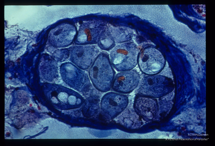 Two slides of necrotic gangrenous colon showing trophozoites in a venule. One slide is stained with H. and E. , the other with Mallory's Trichrome technique.