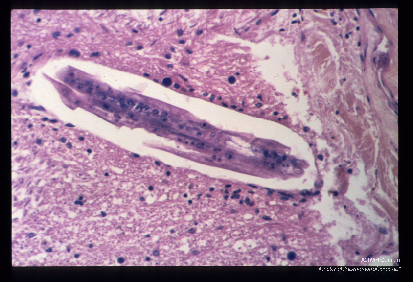 Larva penetrating the arachnoid.