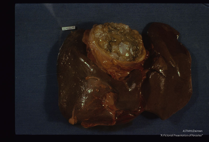 Liver cyst.