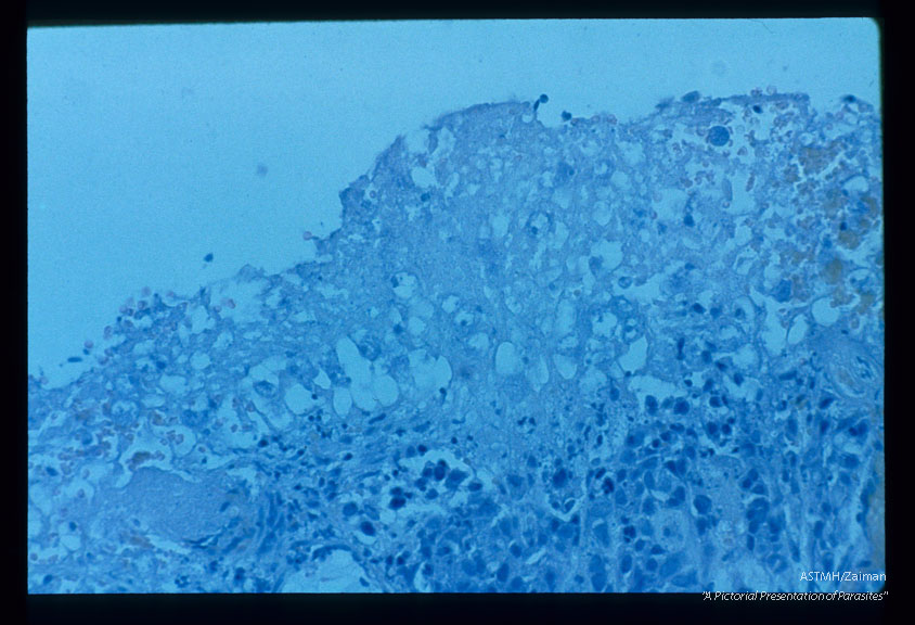 Two microscopic studies from the cervix of a lady suffering from squamous cell cancer of the uterine cervix with simultaneous amoebic cervicitis.