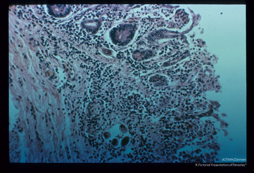 Same case. Portion of adult.