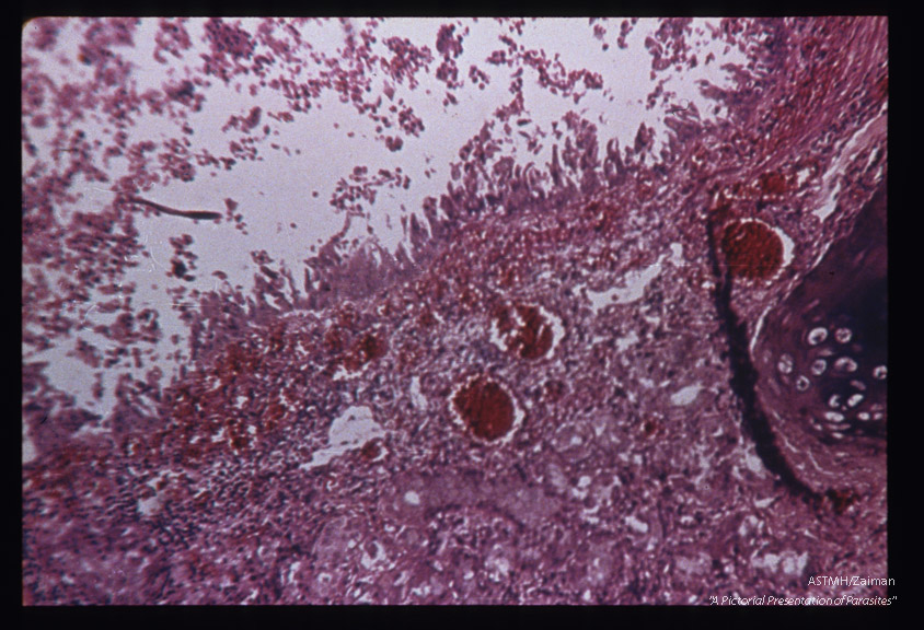 Hematoxylin-eosin stained section of human lung showing larva in alveolus.