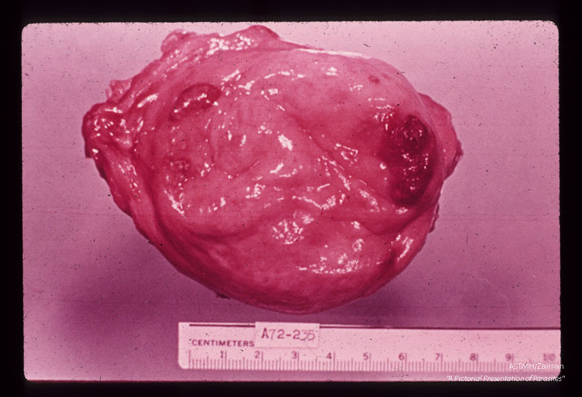 Egyptian male, approximately 10 years old. Urinary bladder with red elevated lesions at the apex and along the right ureteral orifice. Live eggs were not found distant to these foci suggesting that the adult worms nest at one site for some time. Eight pairs of adults were counted in the bladder vasculature.