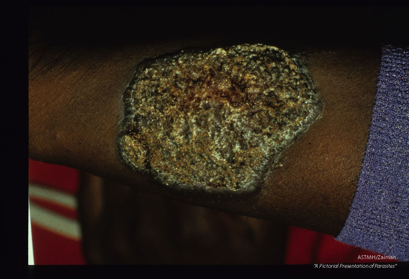 Diffuse cutaneous leishmaniasis. Lesion on forearm.