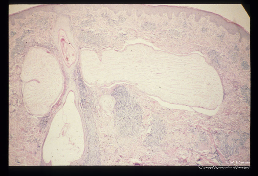 Multiple sections through subcutaneous human tissue containing a sparganum and through the sparganum itself. Note the tremendous inflammatory reaction.