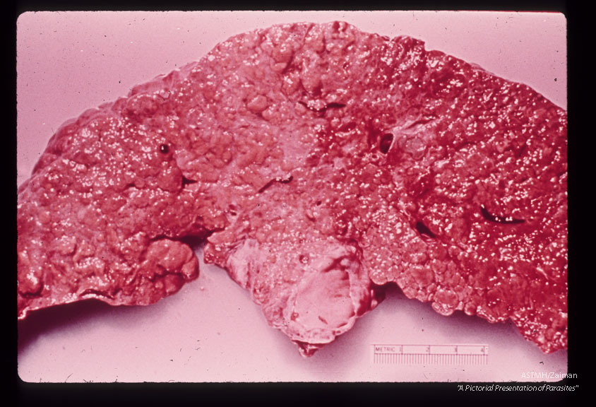 Adult liver fluke crawling from bile duct of transected cirrhotic liver.