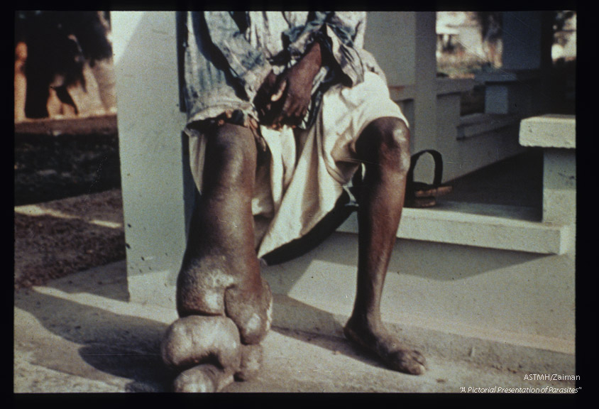 Elephantiasis of lower extremity.