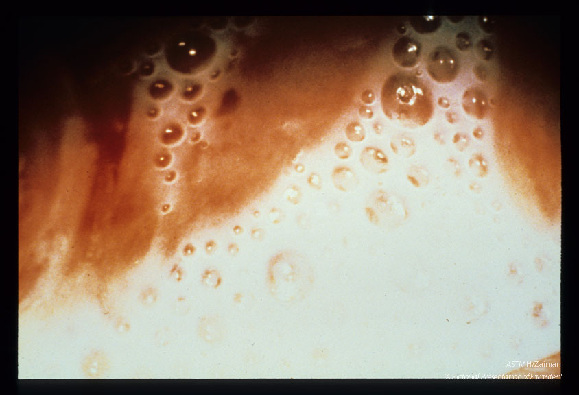 Profuse greenish-yellow bubbly exudate in the vagina.