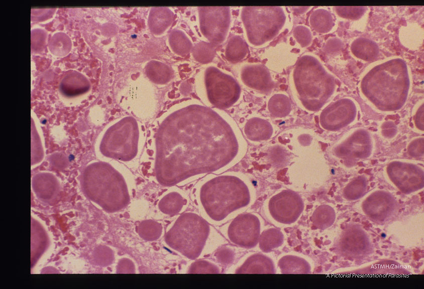 These slides are from a second such case. Reference Amer. Journ. Surg. Path. '11(8): 598-605,1987.