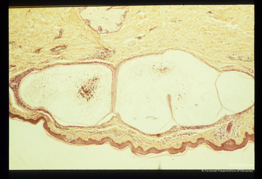 Longitudinal section through worm in human skin. There is little inflamatory reaction adjacent to the worm but perivascular and perineural mononuclear infiltrates are present.