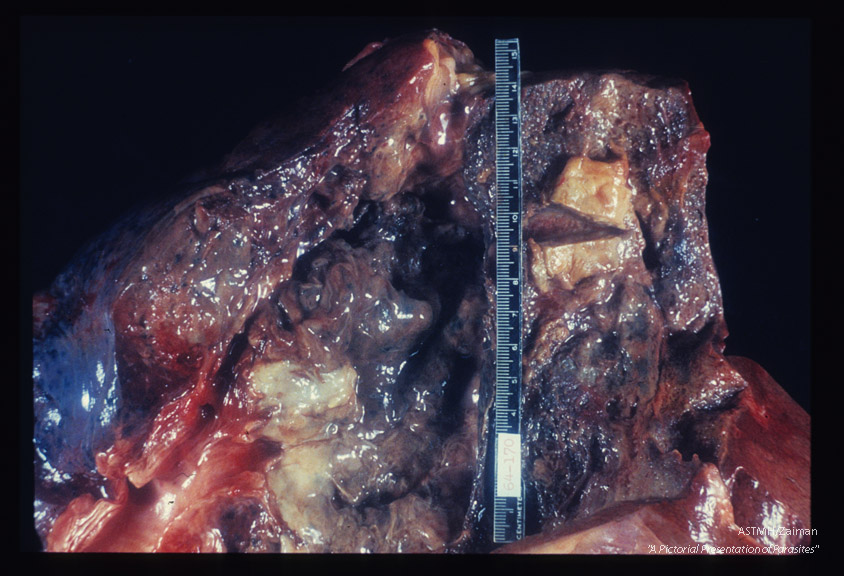 Hepato-pulmonary abscess communicating with bronchus.