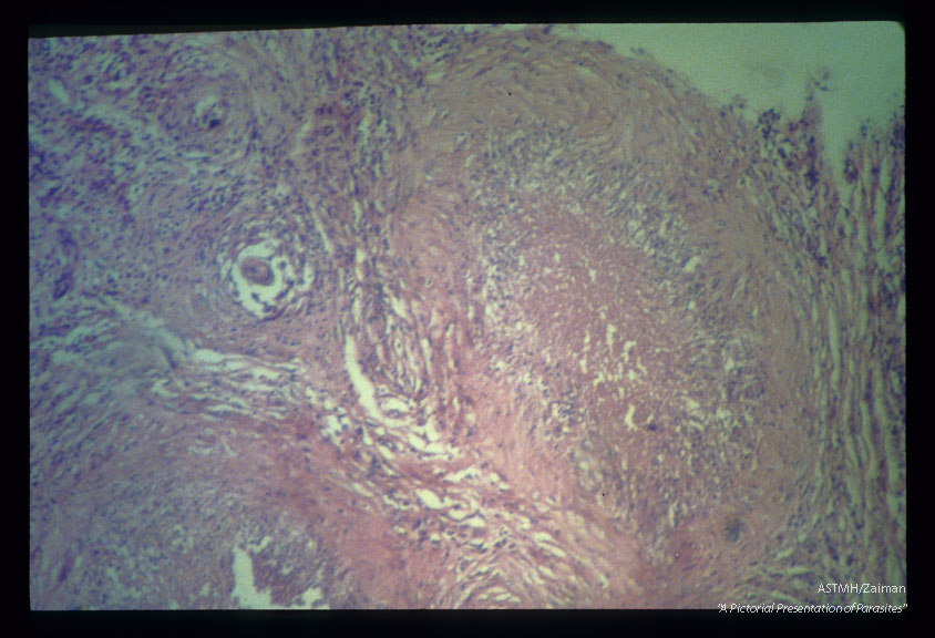 Gross and microscopic photos showing granulomatous formations in testicle as well as adult worm in the pampiniform plexus.