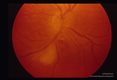Toxoplasmic retinochoroiditis, left eye, approximately 10 days duration.