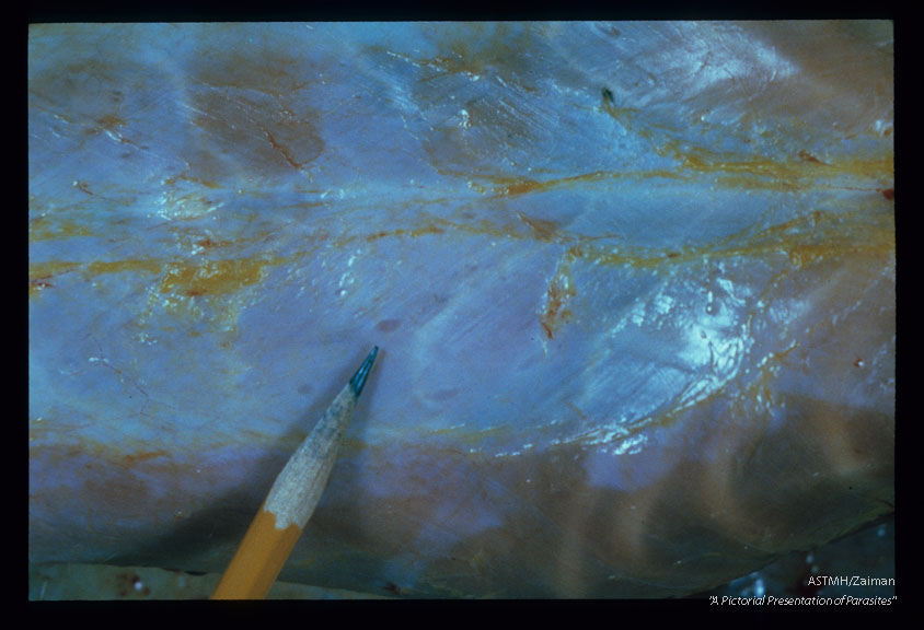 Young worm at the ventral aspect (pencil tip) of the abdominal wall.