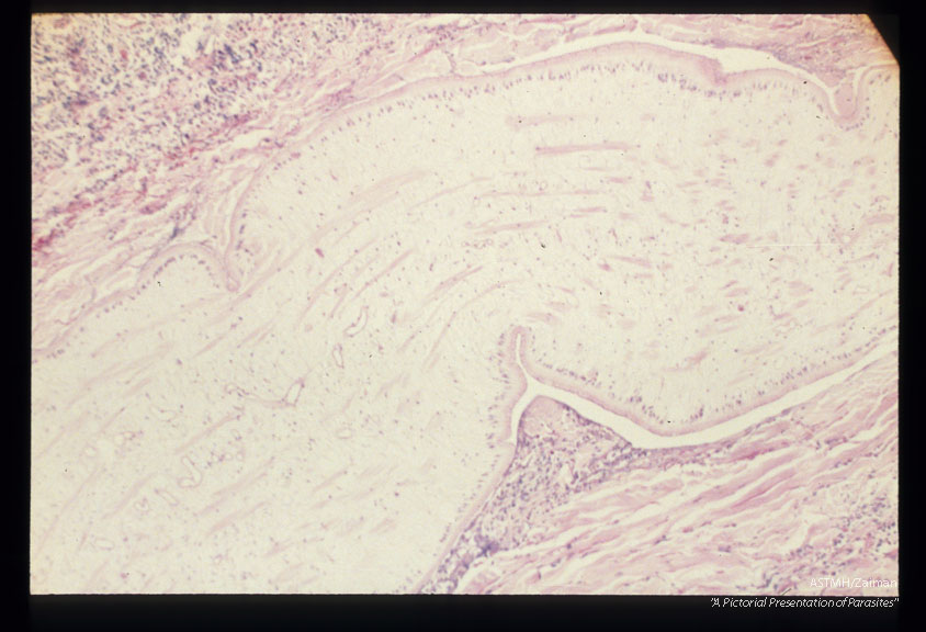 Multiple sections through subcutaneous human tissue containing a sparganum and through the sparganum itself. Note the tremendous inflammatory reaction.