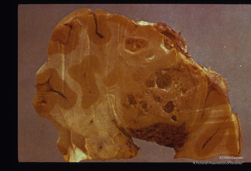 Racemose cyst in brain. Autopsy. Gross specimen.