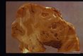 Racemose cyst in brain. Autopsy. Gross specimen.