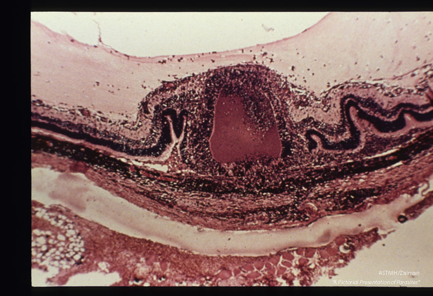 Detail of retinitis associated with cyst rupture, H&E stain.