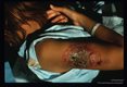 Twenty-eight year old Mexican lady had a skin lesion for six months. She developed CNS symptoms including headache and nausea. Note position of head.
