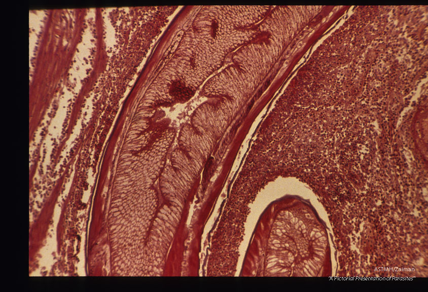 Low and high power magnifications of worm in human stomach wall. Case from Holland.