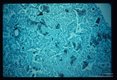 Pneumonia. High power view of infected lung stained with silver methenamine. Parasitic borders are often sharply outlined in black. Fewer nuclei are seen.