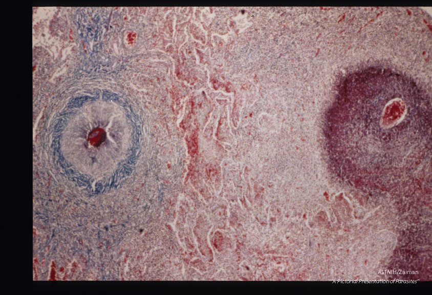 Fibrotic (1180) and necrotic pulmonary reactions to eggs.