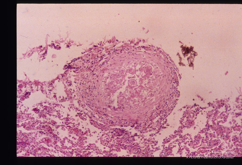 Same case. Pulmonary granulomas with larvae.