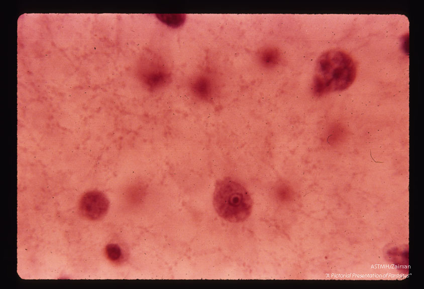 Lee case of primary amoebic meningoencephalitis. Ventricular fluid. Hematoxylin stain, oil immersion.