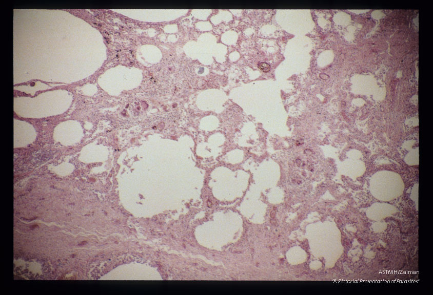 Section of lung from 16 year old Philippine female who died of schistosomal pneumonitis.