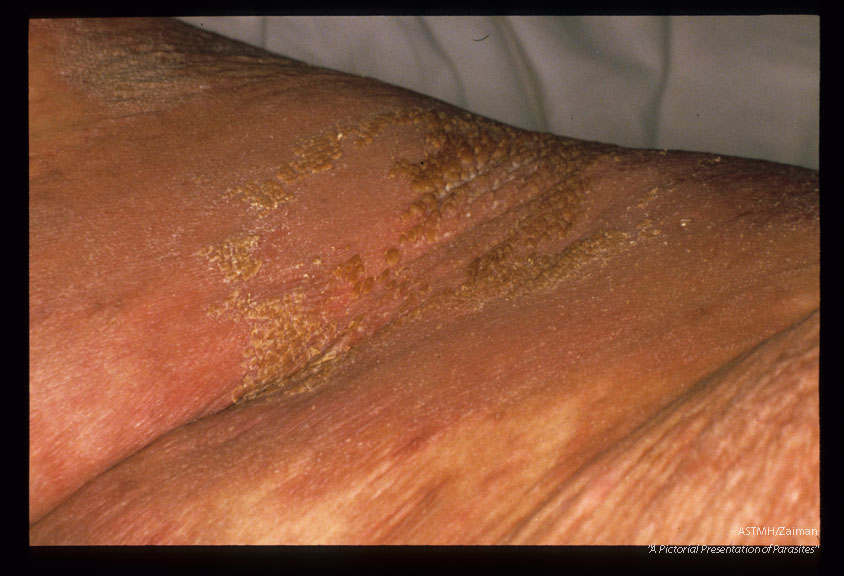 Severe skin lesions. "Norwegian scabies".