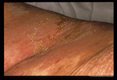 Severe skin lesions. 