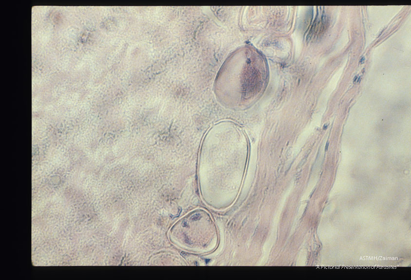 Eggs in the frontal lobe of the brain of a female Korean immigrant.