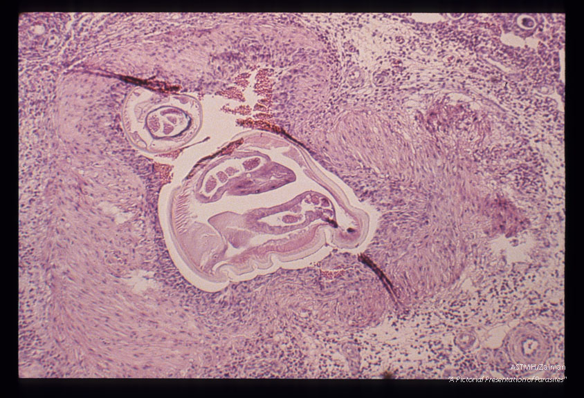 Microscopic views of rat lung reaction to the nematodes.