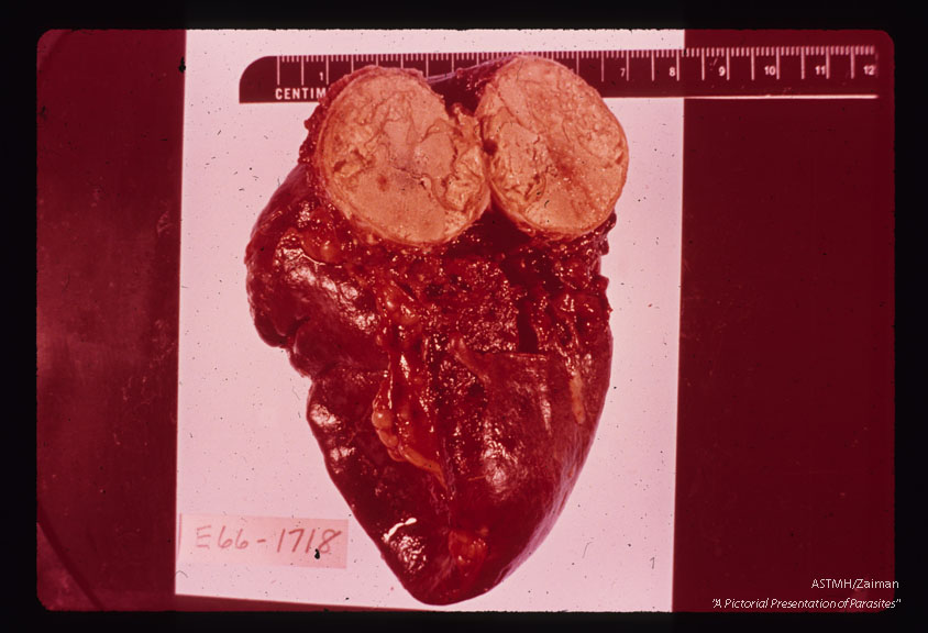 Solid cyst in spleen.