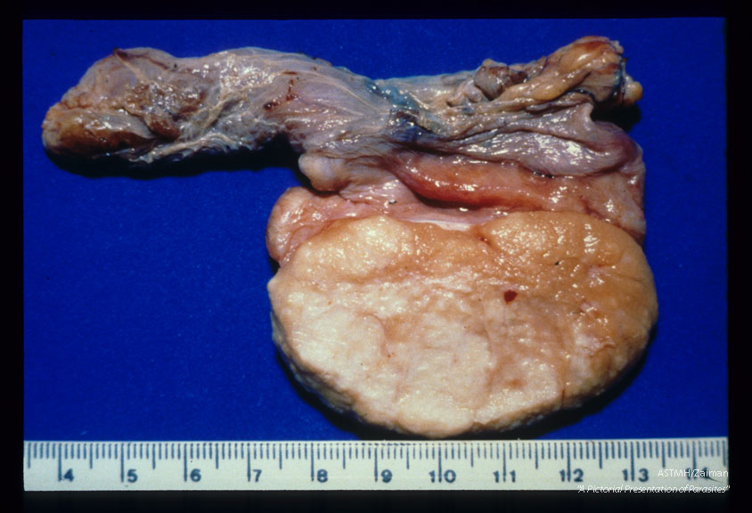 Gross and microscopic photos showing granulomatous formations in testicle as well as adult worm in the pampiniform plexus.